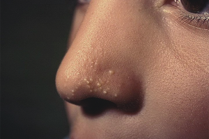 Hvordan bli kvitt hvite prikker i ansiktet ditt