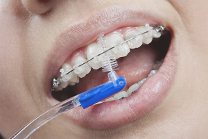 Hvordan pusse tennene med seler
