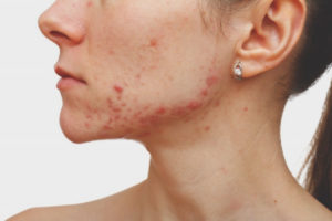L'acné sur le menton chez la femme