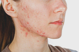 L'acné sur les pommettes des femmes