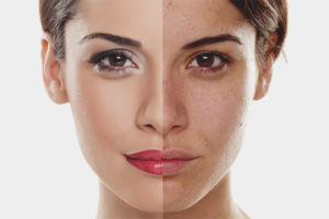 Comment égaliser la peau après l'acné