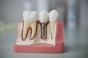 Implantation dentaire